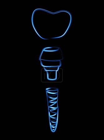 Vector isolated illustration of dental implant with neon effect.