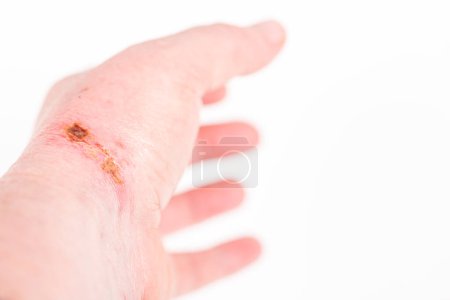 Photo for Chemical burn on the wrist skin with hydroxide sodium acid, by striping paint from wood. Festering and deep wound. Household accident, because of gloves to sharp. Selective focus - Royalty Free Image
