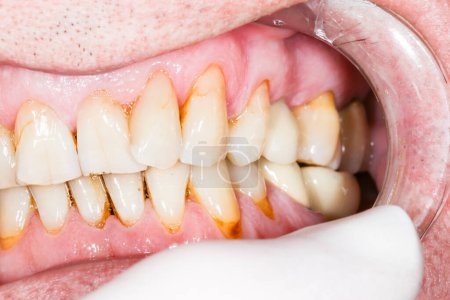 Photo for Close up macro shot of interior of mouth and fillings and crowns on teeth, with plaque tartar. Need teeth whitening. At dental office, with mouth opener - Royalty Free Image