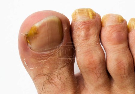 Close up Pilz auf den Nägeln eines Mannes Fuß auf weißem Hintergrund