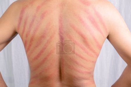 Der rote Fleck auf dem Rücken des Mannes wurde durch Gua Sha verursacht. Gua sha ist eine natürliche alternative Therapie zur Verbesserung der Durchblutung oder zur Heilung von Erkältungssymptomen