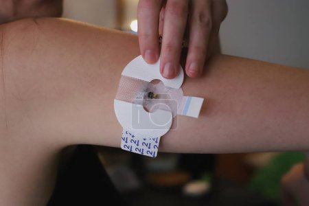 Foto de Aplicación de la pegatina para el sensor de glucosa en sangre - Imagen libre de derechos