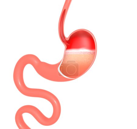 Photo for Anatomical 3D illustration of the inside of the stomach doing digestion. With heartburn and reflux. Cut out on white background. - Royalty Free Image