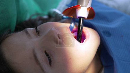 Odontología láser: primer plano de la boca del niño aplicando láser, niña pequeña en la oficina de Destic