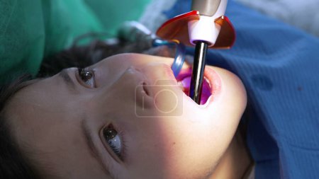 Odontología láser: primer plano de la boca del niño aplicando láser, niña pequeña en la oficina de Destic