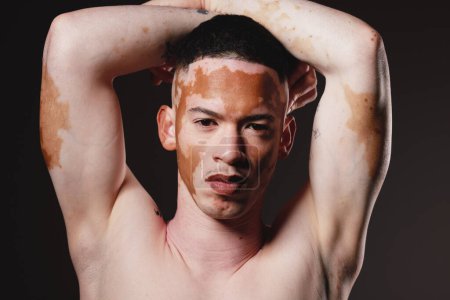 Skincare, beauty and portrait of man with vitiligo on black background for wellness, dermatology and body care. Fashion, cosmetics and face of male with natural, healthy and glowing skin in studio.