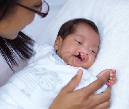 Foto de Mostrando su fuerte agarre. Un bebé con paladar hendido sosteniendo el dedo de su madre y sonriendo - Imagen libre de derechos