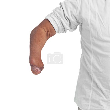 Photo for Disability, unique and arm amputee of a man with a injury showing forearm with mockup. Isolated, disabled model and white background of a male person pose with a different body and mock up space. - Royalty Free Image