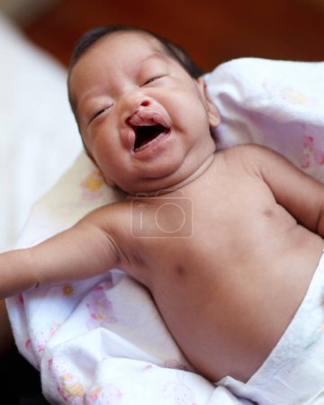 Foto de Labio leporino, bebé y parto con un retrato de un recién nacido llorando en su cuna en casa. Cuidado de niños, niño pequeño y bebé con una condición médica que se coloca en una manta en su guardería en el hospital. - Imagen libre de derechos