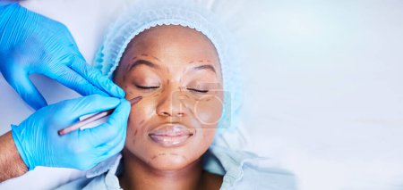 Photo for Plastic surgery, pen and black woman sleep on a hospital bed with dermatology with mockup space. Surgeon, facial change and medical filler for skincare, cosmetics and wellness in a clinic with doctor. - Royalty Free Image