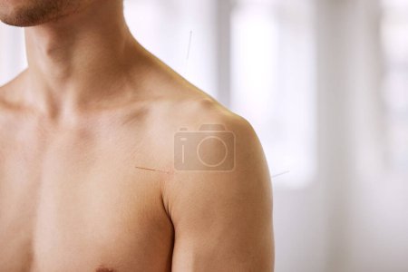 Photo for Acupuncture, man and treatment of body for healthcare, healing muscle or relief from back pain. Healthy, patient and physiotherapy with dry needling to relax nervous system, injury or holistic care. - Royalty Free Image