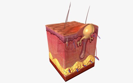 Acne is caused by a combination of factors acting on sebaceous (oil) glands and hair follicles in the skin. 3D illustration