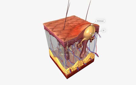 Acne is caused by a combination of factors acting on sebaceous (oil) glands and hair follicles in the skin. 3D illustration