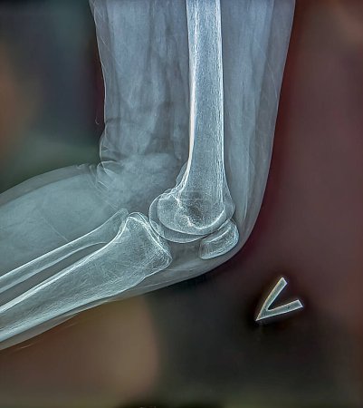 Röntgen zeigt das Skelett des Knies auf Film. Chirurgisches Medizintechnikkonzept.