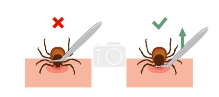 Correct way to remove tick of skin after bite insect correctly, vector illustration. Tips for tick showing safety infographic. Isolated on white background.