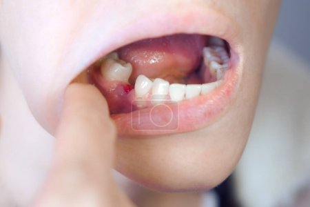 Photo for Woman is looking on her removed sixth tooth with an inflamed gum, closeup view inside of mouth. Dental treatment, care. Orthodontic cure. Healing of dental wounds. - Royalty Free Image