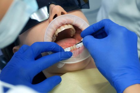 Photo for Dentist is preparing womans teeth for installing ceramic veneers and crowns. He is applying liquid on her teeth. Dental treatment. Dentistry, prosthodontics, prosthetics concept. Orthodontist cure. - Royalty Free Image