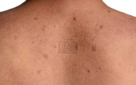 Schwarze Flecken und Narben auf dem Rücken des asiatischen, myanmarischen Mannes