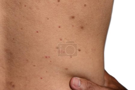 Téléchargez les photos : Taches noires, boutons, acné et cicatrices sur le dos de l'homme asiatique, Myanmar - en image libre de droit