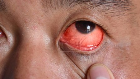 Foto de Infección corneal o úlcera llamada queratitis en el hombre asiático chino. - Imagen libre de derechos
