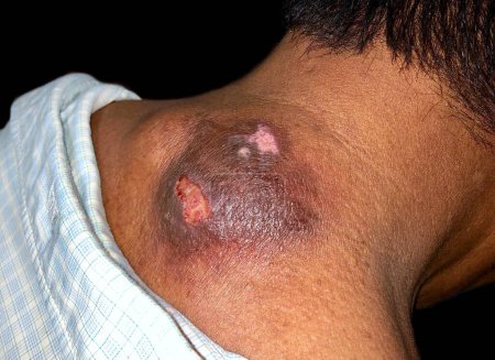 staphylococcal