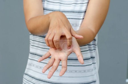 mujer asiática joven rascarse picazón con la mano en el área de la palma, concepto de atención médica, dermatosis