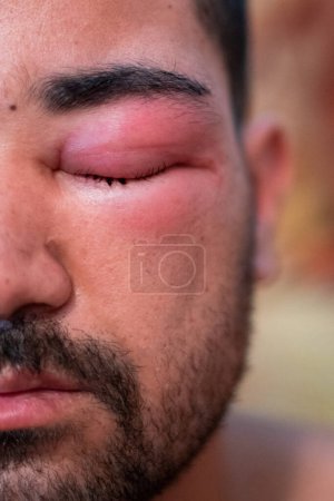 Foto de Hombre adulto con el ojo hinchado de una picadura de abeja - Imagen libre de derechos