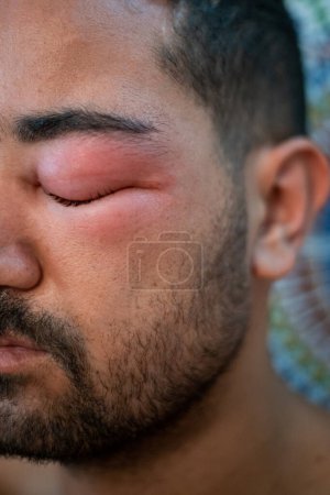 Hombre adulto con el ojo hinchado de una picadura de abeja