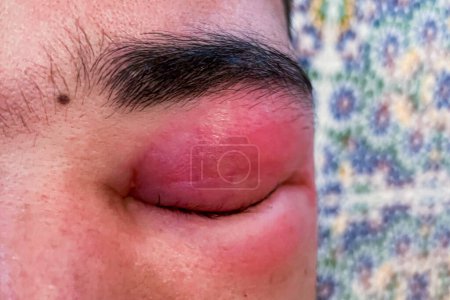 Foto de Hombre adulto con el ojo hinchado de una picadura de abeja - Imagen libre de derechos