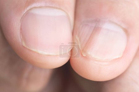 Im Vergleich Daumen links ist ein normaler Finger rechts ist eine Fingerverletzung. Nägel sind schief gebaut.