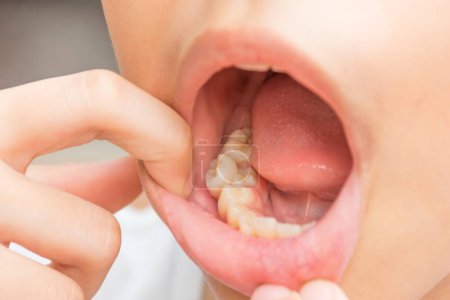Zähneknirschend. Malokklusionszähne. In den Mund dieses Kindes mit bleibenden Zähnen legen Sie die Milchzähne ein, die nicht gefallen sind.