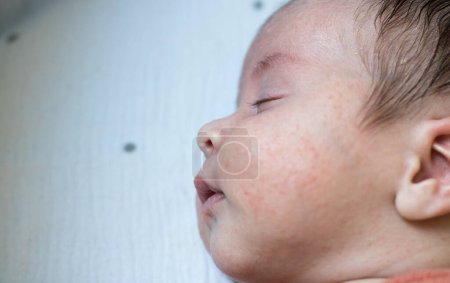 Téléchargez les photos : Nouveau-né bébé mignon avec dermatite du visage ; concept médical et pédiatrique - en image libre de droit