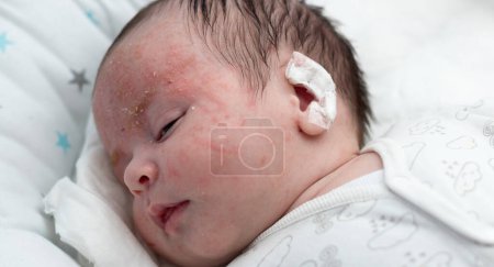 Foto de Recién nacido lindo bebé con una medicación en la oreja; tema médico y pediátrico - Imagen libre de derechos