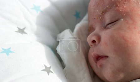 Téléchargez les photos : Nouveau-né bébé mignon avec dermatite du visage ; concept médical et pédiatrique - en image libre de droit