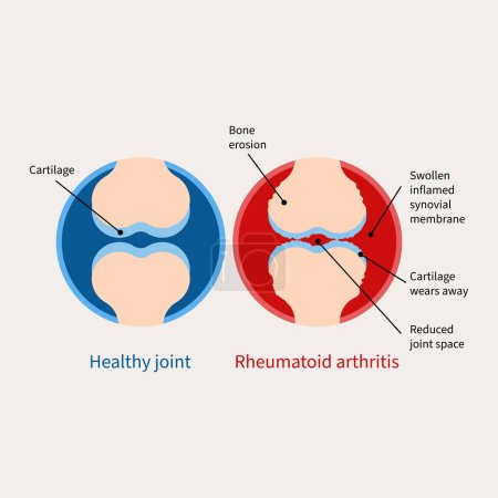 Ilustración de Ilustración de artritis reumatoide. Enfermedad autoinmune, tipo inflamatorio de artritis - Imagen libre de derechos