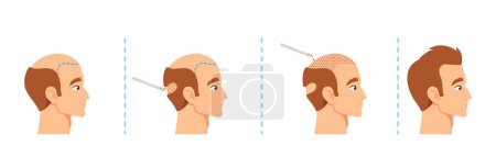 Illustration for Hair Transplantation Procedure Stages, Male Scalp Before And After. Visual Aids For Medical Presentations Or Educational Materials Related To Hair Restoration. Cartoon People Vector Illustration - Royalty Free Image