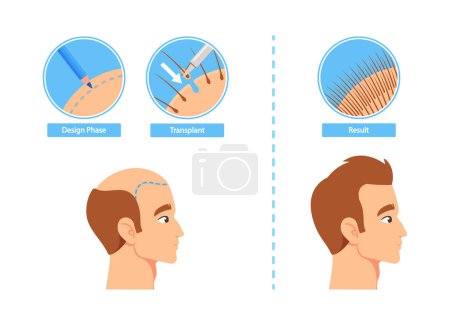 Illustration for Hair Transplantation Process Infographics Including Design Phase, Transplant and Result Stages. Before and After Images for Male Patient Applying Plastic Surgery Procedure. Cartoon Vector Illustration - Royalty Free Image