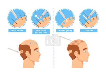 Ilustración de Hair Transplantation Procedure Infographics. Punch Incision, Extraction of Follicular Units, Channel Opening and Transplant Stages For Medical Or Health-related Content. Cartoon Vector Illustration - Imagen libre de derechos