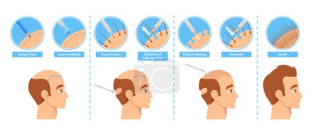 Illustration for A Step-by-step Infographic To Hair Transplantation Procedure. Design Phase, Local Anesthesia, Punch Incision, Extraction of Follicular Units, Channel Opening and Result. Cartoon Vector Illustration - Royalty Free Image