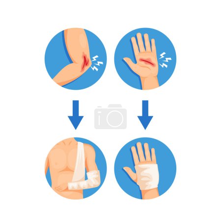 Ilustración de Process Of Injury Treatment and Bandaging, Infographics For Healthcare Or Medical-related Content. Hand With Wound Being Wrapped and Bandaged With White Bandage. Cartoon Vector Illustration - Imagen libre de derechos