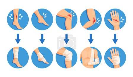 Hand- und Beinbandage, Wickelverbände um eine verletzte Stelle. Infografiken für Gesundheitswesen, Erste Hilfe oder medizinische Ausbildungsinhalte. Zeichentrickvektorillustration