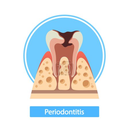 Ilustración de La sección transversal de la periodontitis revela tejido inflamado de la encía, infección bacteriana y pérdida ósea. La condición progresiva puede conducir a la movilidad de los dientes y la pérdida eventual de los dientes. Ilustración de vectores de dibujos animados - Imagen libre de derechos