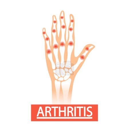 Main humaine avec arthrite Illustration vectorielle médicale. Main gonflée et déformée à mobilité réduite, caractérisée par des articulations enflammées, des difformités et éventuellement des nodules, signe d'arthrite