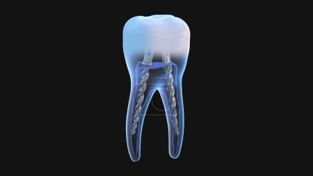Foto de Poste de acero dental dentro de los dientes molares, vista de rayos X. Tratamiento endodóntico dental Ilustración 3D - Imagen libre de derechos