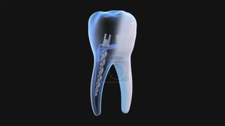 Poteau en acier dentaire à l'intérieur des dents molaires, vue par rayons X. Traitement endodontique dentaire Illustration de rendu 3D