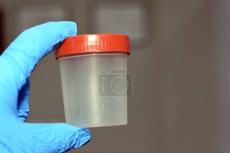 Foto de Un recipiente de prueba de orina de plástico para análisis de laboratorio análisis de orina, una prueba para detectar y controlar una amplia gama de trastornos, como infecciones del tracto urinario, enfermedades renales y diabetes. - Imagen libre de derechos