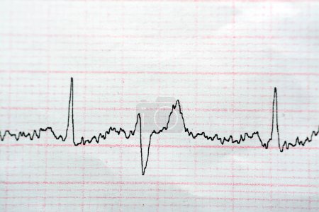 Téléchargez les photos : ECG ElectroCardioGraph paper that shows Normal Sinus Rhythm NSR with frequent PACs Contractions auriculaires prématurées, CVP Contractions ventriculaires prématurées, anomalie ST-T latérale, ischémie myocardique - en image libre de droit