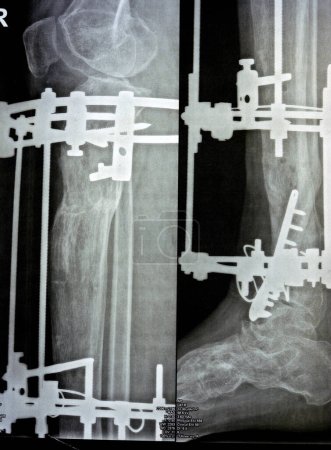 Photo for Distal comminuted fracture fibula managed by plate and screws, distal tibia managed by external ring fixator ILIZAROV frame with sclertoic bone resection and proximal corticotomy and segment transfer - Royalty Free Image