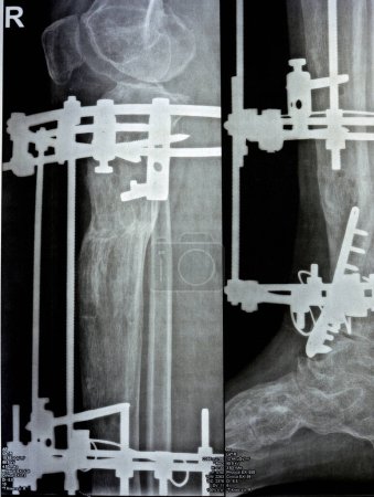 Foto de Fíbula de fractura conminuta distal manejada por placa y tornillos, tibia distal manejada por fijador de anillo externo marco ILIZAROV con resección ósea esclertoica y corticotomía proximal y transferencia de segmento - Imagen libre de derechos