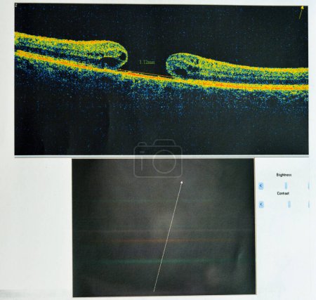 Foto de OCT del ojo revela débil membrana epimacular y agujero macular de espesor completo que afecta a la fóvea, rodeando edema macular difuso que muestra pocos cambios cistoides para el seguimiento, enfoque selectivo - Imagen libre de derechos